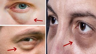 How to Get Rid of Bags Under Eyes at Home || 9 Home Remedies for Puffy Eyes and Bags Under Eyes