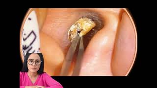 satisfying asmr relaxing video earwax removal.