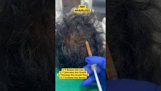 बालों का झड़ना , गंजा होना , बालों का पतला होना #hair #prp #hairtransplant #ytshorts #shorts #viral