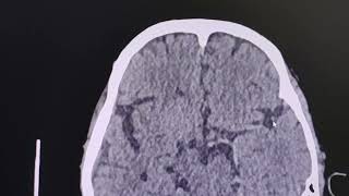 Acute cerebral infarct due to left middle cerebral artery thrombosis - CT findings