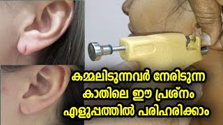 earlobe repair | കമ്മലിടുന്നവർ നേരിടുന്ന ഈ പ്രശ്നം എളുപ്പത്തിൽ പരിഹരിക്കാം | The Malayalam Vlogs