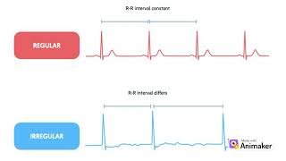 ECG interpretation | Easy understanding | Heart rhythms. #youtubevideo #viral_video