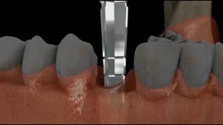 Implant: Metal, PFM Crown