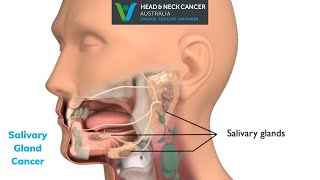 Salivary Gland Cancer  - What Is It?  What are the Symptoms and Treatment?    Head and Neck Cancer