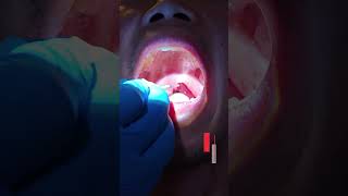 How to Drain an Quinsy ( Abscess in your Throat ! ) +18 content