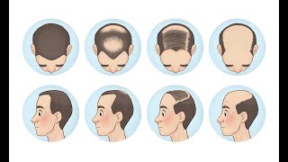 Male Pattern Baldness Treatment | Hair Loss & Hair For Treatment for Men in  Mumbai, India