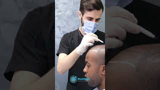 Hair Transplant Surgery in Istanbul