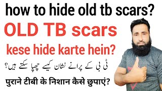 How to hide old TB scars | remove old tb scars | old tb scars not showing in X-ray | info online