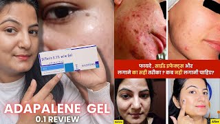 How to Use Adapalene Gel 0.1? | Full Detail Video | Best Gel For Removing Blackheads and Pimples