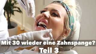 Durchsichtige Zahnspange von DrSmile - Teil 3 / Alicia_Wunderbar