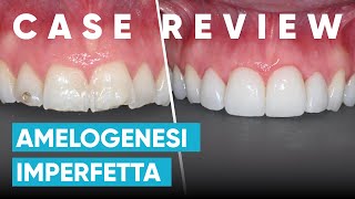 Imperfezioni di forme e colore dei denti: ecco cos'è l'AMELOGENESI IMPERFETTA | Case Review #4