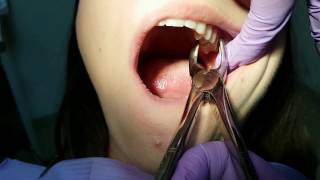 TOOTH EXTRACTION - how to use dental forceps [ Shown on a patient ]