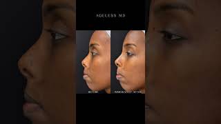 PDO Nose - Nonsurgical Nose job using threads