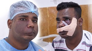 Hemangioma Removal Surgery on the Face: 7 Days Follow up!!