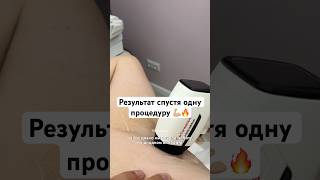 Результат лазерной эпиляции спустя 1 сеанс 🔥