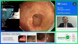 06. Гонконг. Выраженная дисплазия желудочного антрального отдела желудка. Хончи Йип, Джеймс Лау