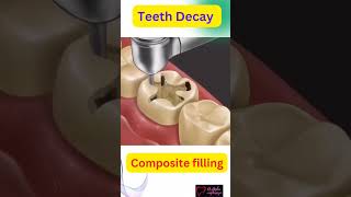 Teeth Decay #cavities #shorts #dentistry #dentalcare #composite