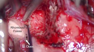 Microsurg resect of brainstem cervicomedullary ganglioglioma: surg pseudoplane for near-total resect