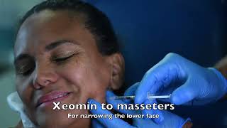 Xeomin browlift and masseters V