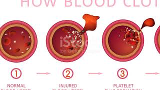 Blood clot: The silent Threat. #shorts #youtubeshorts