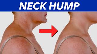 HOW TO FIX A NECK HUMP AT HOME AT THE WALL