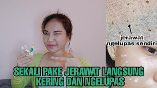 TOP 3 ACNE SPOT (Obat Totol Jerawat Paling Ampuh) | Aku Itin