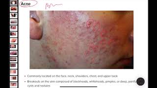 Acne | Pimples | Skin disease #shortvideo #shortsfeed #shorts #short #viral #viralshort #shortsviral