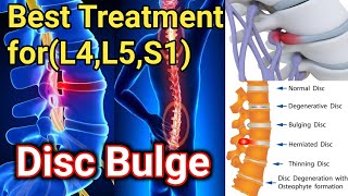 Disc Bulging/Herniation  L4,L5,S1 Treatment