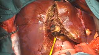 The Two-Surgeon Technique for Hepatic Parenchymal Transection