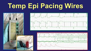 Surgical epicardial pacing wires - uses and management