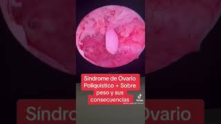 Síndrome de ovario poliquístico #fiv #infertilitycauses #infertilidad #invitro #ovariopoliquistico