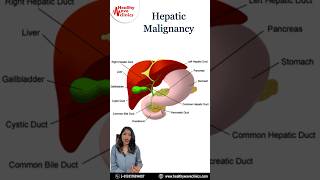 Gall bladder Cancer Management #drrekha_oncologist #cancer #ytviral #fightagainstcancer #ytshorts#yt