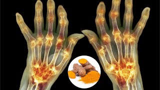 How to Use Turmeric for Arthritis