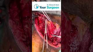 Diabetic Foot Cellulitis Treatment I Debridement I Nonhealing Ulcer ABSCESS