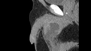 Penis infiltrating lesion - CT scan