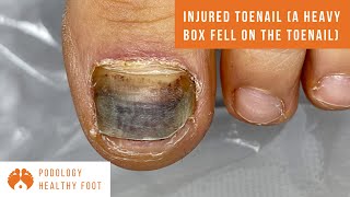 Injured toenail a heavy box fell on the toenail ***asmr treating an injured toenail*** super ZOOM!