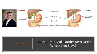 Gallbladder Removed: What To Do Now?