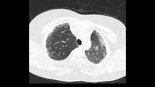 Fibrose pulmonar idiopática PIU