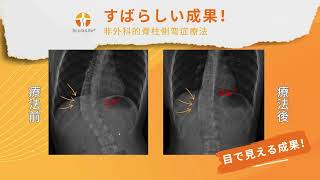 ScolioLifeクリニック：脊柱側弯症の目に見える成果（ケース 10）