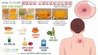 How to Cure a MRSA Infection Naturally