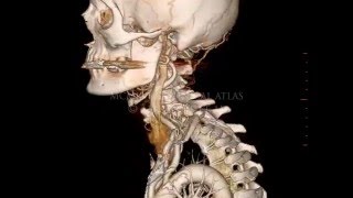 3D Head and Neck Arterial Tree