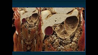 CT Evaluation of GI Bleeding - Part 1