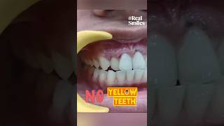 Say NO to Yellow Teeth: Teeth Whitening Process; Dr. Srishti Bhatia #smile #teethwhitening