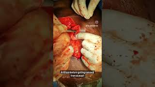 পেট থেকে বাধানো দাত বেরোল।কি অবস্থা.??🤦‍♂️Denture taken out from stomach.#viralshorts #viralsurgery