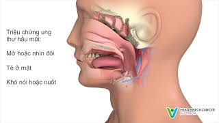 Vietnamese - What is Nasopharyngeal Cancer? Signs & Symptoms. Head and Neck Cancer