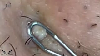 Severe Cystic Acne - Whitehead Blackhead Removal - Pimple Popping Treatment - Acne Spa Relax | #122