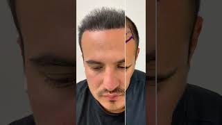 Hair Transplant Impressive Results - Before and After