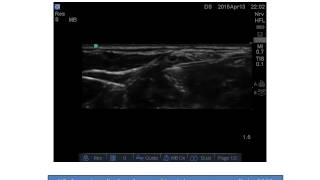 Quick Discharge after Shoulder Dislocation: USG Guided Interscalene Block