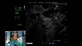 Pancreas lymphoepithelial cyst