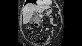 Choledocholithiasis - CT findings